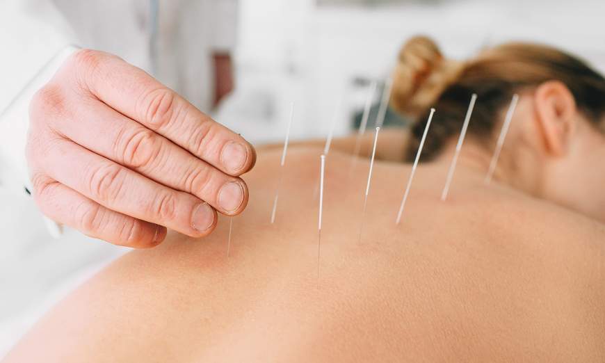 Descubre la función de las agujas acupuntura, cuánto tiempo deben permanecer en el cuerpo y qué tipos existen.